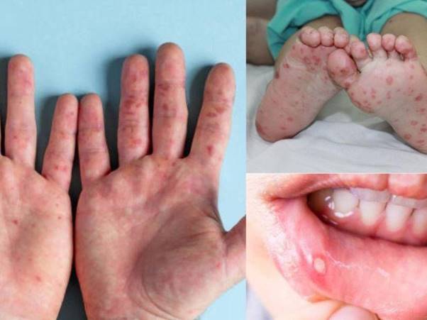 Bệnh tay chân miệng- Dấu hiệu nhận biết và cách phòng ngừa